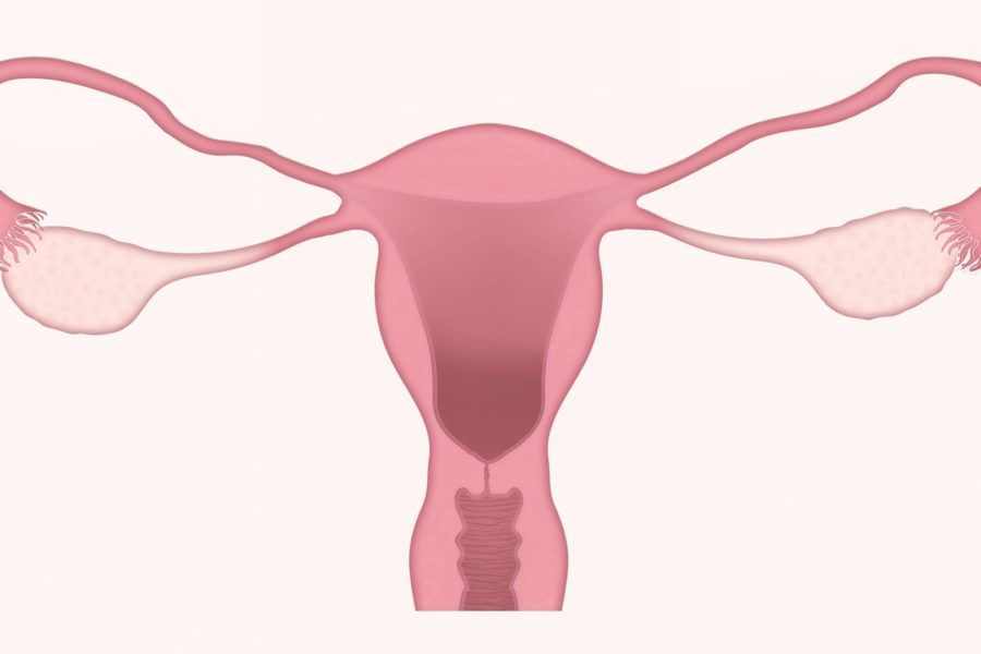 Polycystic Ovary Syndrome