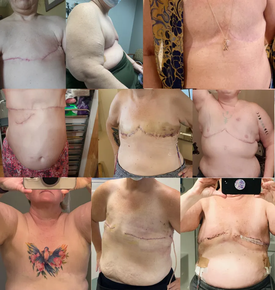 Double Mastectomy Scars